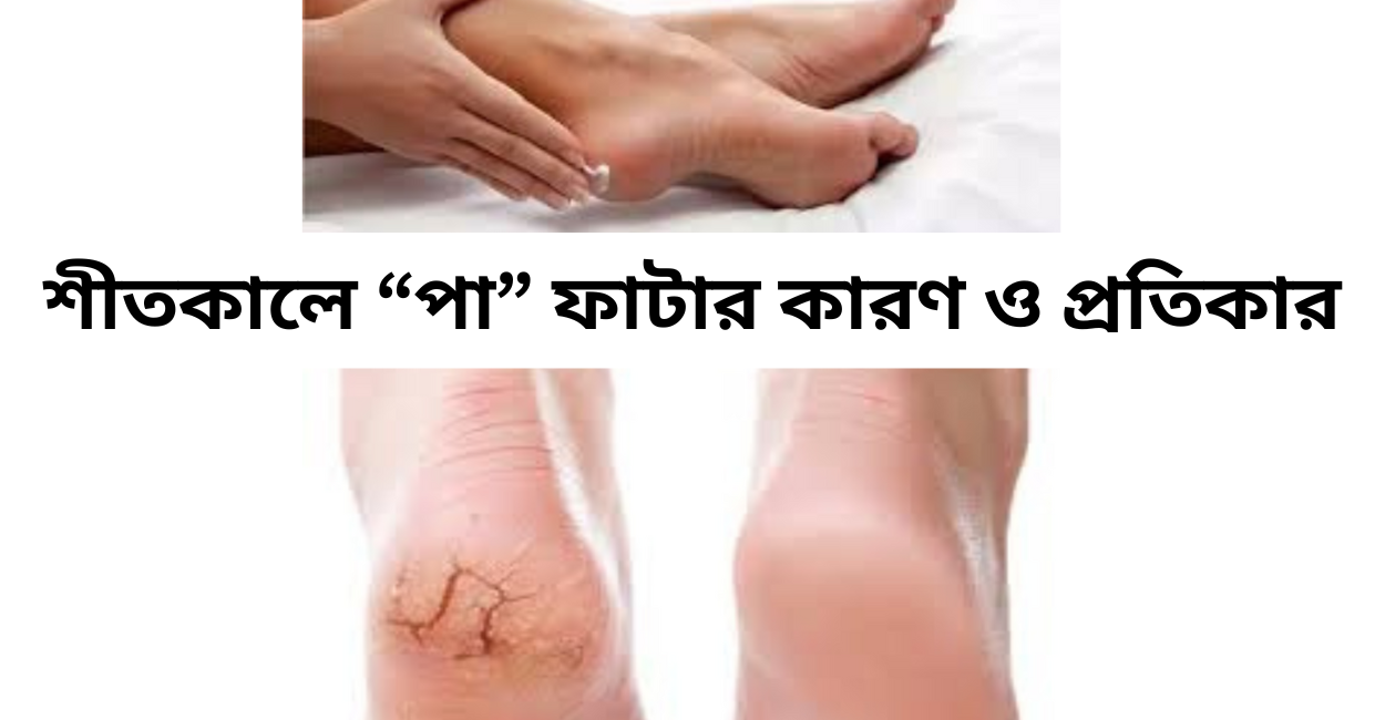 শীতকালে পা ফাটার কারণ ও প্রতিকার